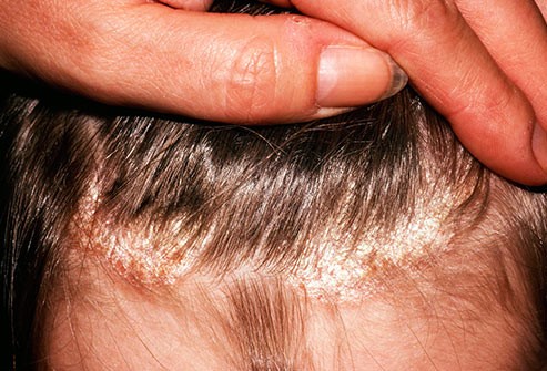 Tratamientos-caseros-para-la-psoriasis-del-cuero-cabelludo